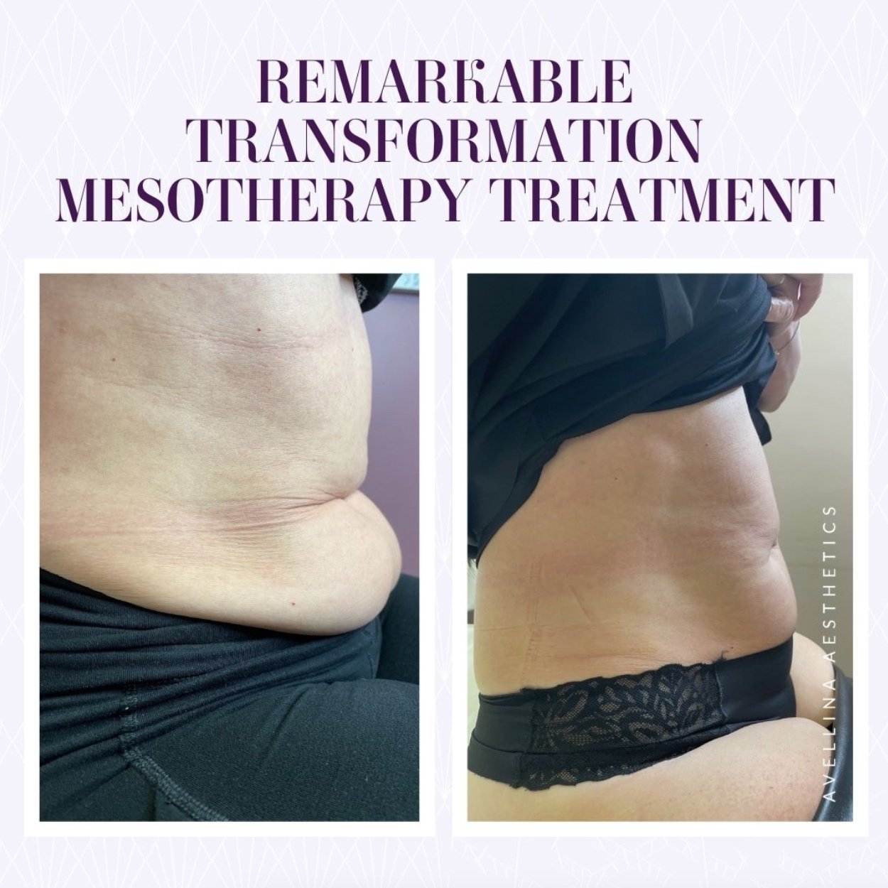 Mesotherapy used to melt stubborn belly fat
