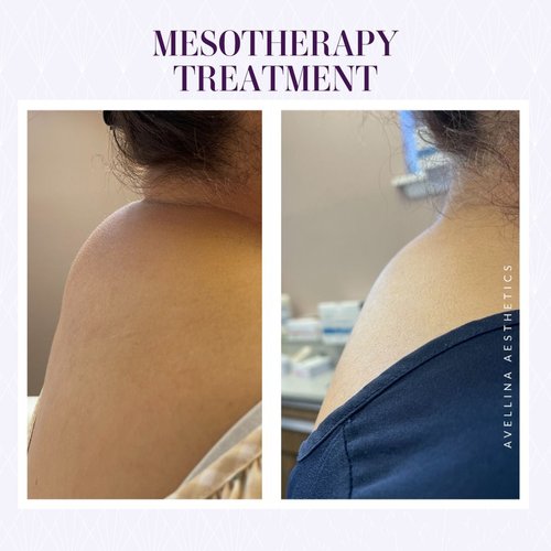 Mesotherapy to melt away back hump.jpg