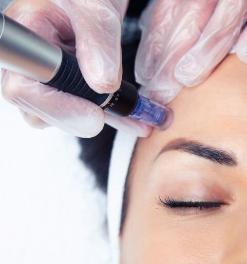 side-effects of microneedling.jpg