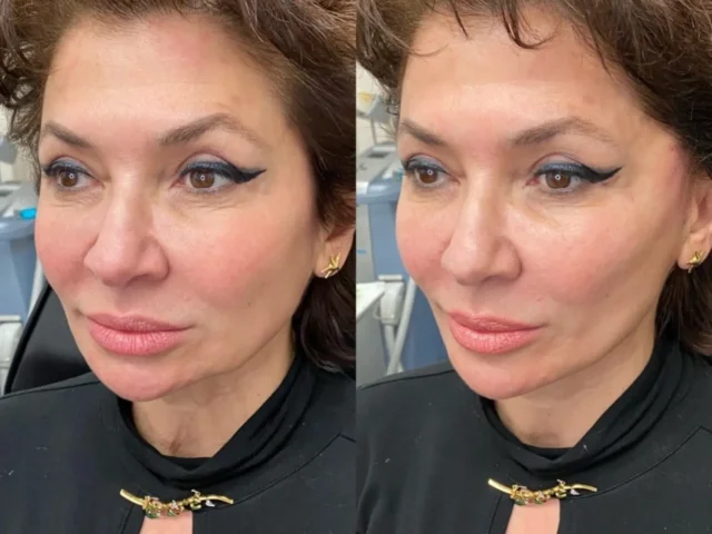 Before Getting Mesotherapy: Understand the Risks, Benefits, and How to Pick the Best Clinic